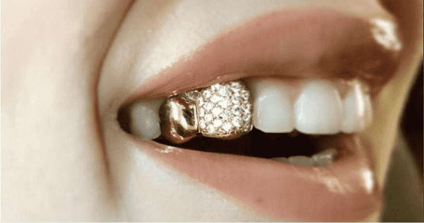 Скупка золотых зубов